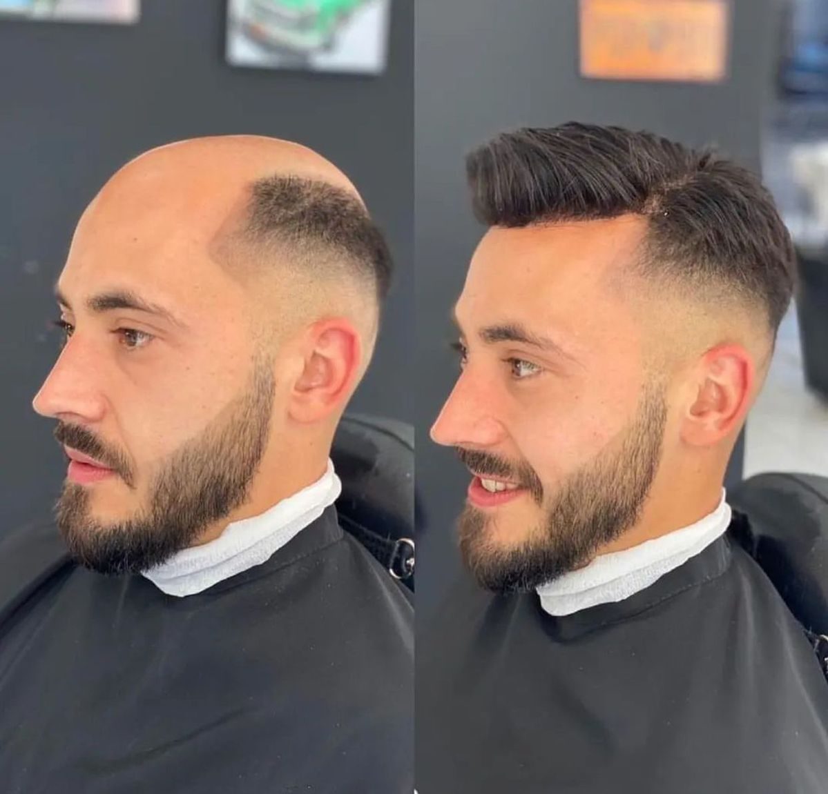 Hair Patch Before and After Transformation